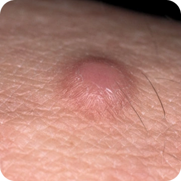 Dermatofibroma