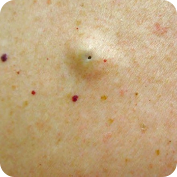 Epidermāla cista