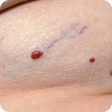Hemangioma