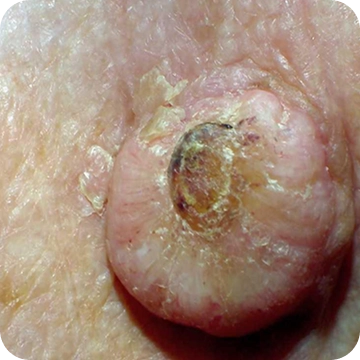 Keratoakantoma 