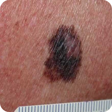 Melanoma