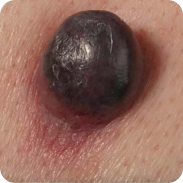 Melanoma