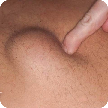 lipoma