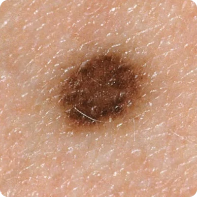 Melanocītiskais nevus (dzimumzīme) (1)