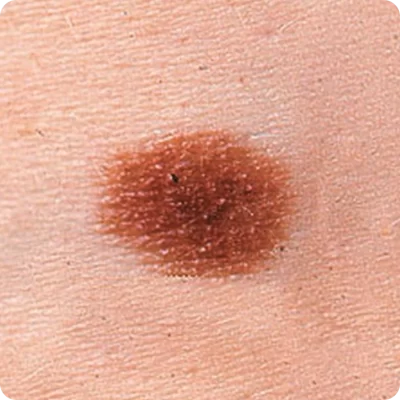 Melanocītiskais nevus (dzimumzīme) (1)