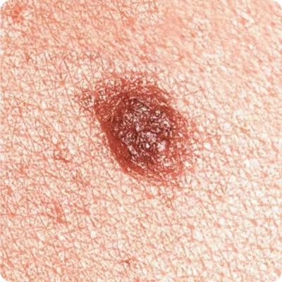 Melanocītiskais nevus (dzimumzīme) (1)