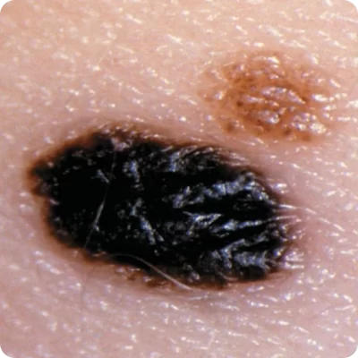 Melanocītiskais nevus (dzimumzīme) (1)